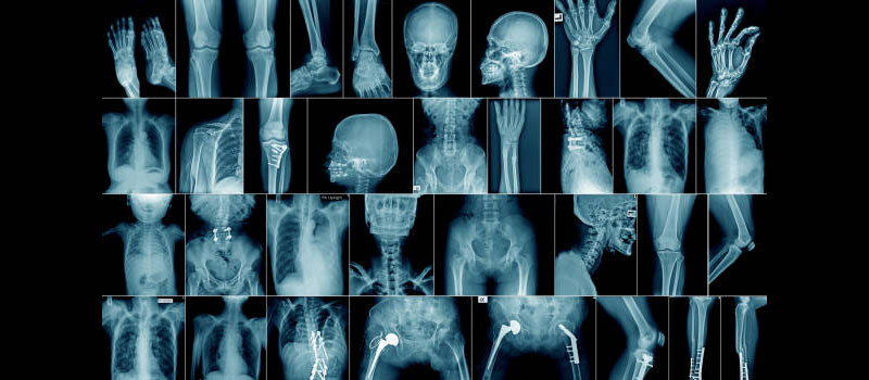 Complete Body X-Ray at Home in Mumbai Complete Body X-Ray at Home in Mumbai