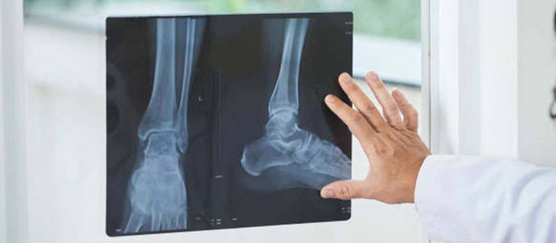 Fracture X-Ray at Home in Mumbai Fracture X-Ray at Home in Mumbai