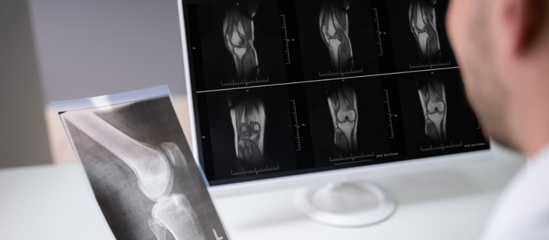 Knee X-Ray at Home in Mumbai Knee X-Ray at Home in Mumbai