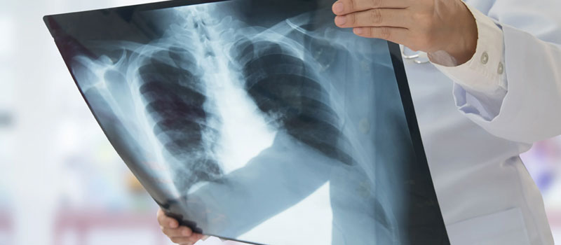 Safe Chest X-Ray at Home in Mumbai Safe Chest X-Ray at Home in Mumbai